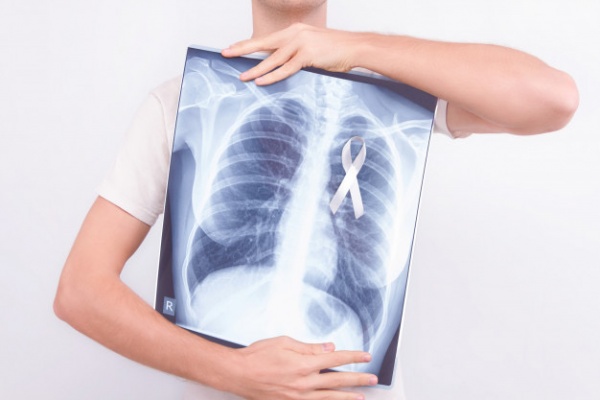 Akciğer kanseri tedavisinde dikkat edilmesi gereken hususlar